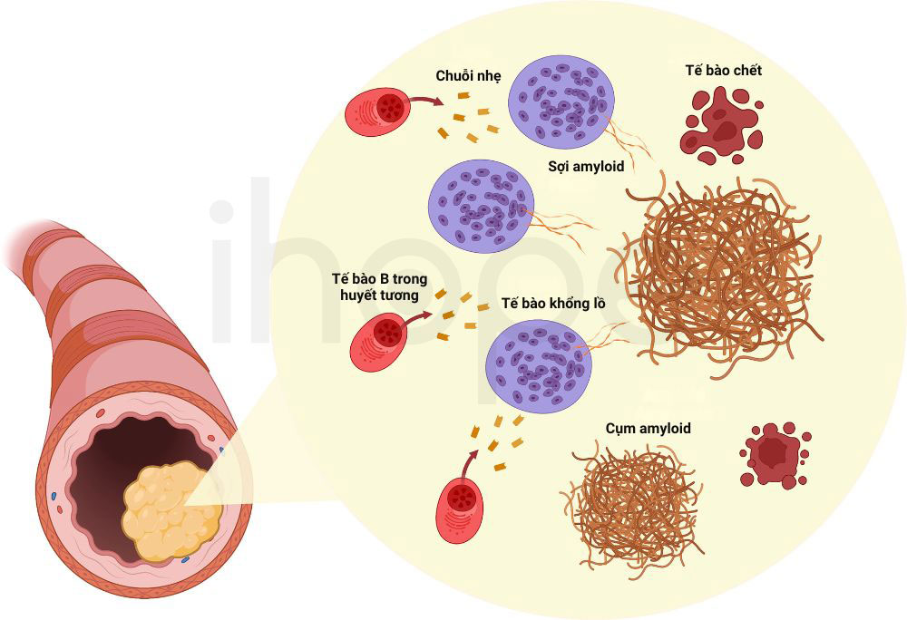 Amyloidosis al