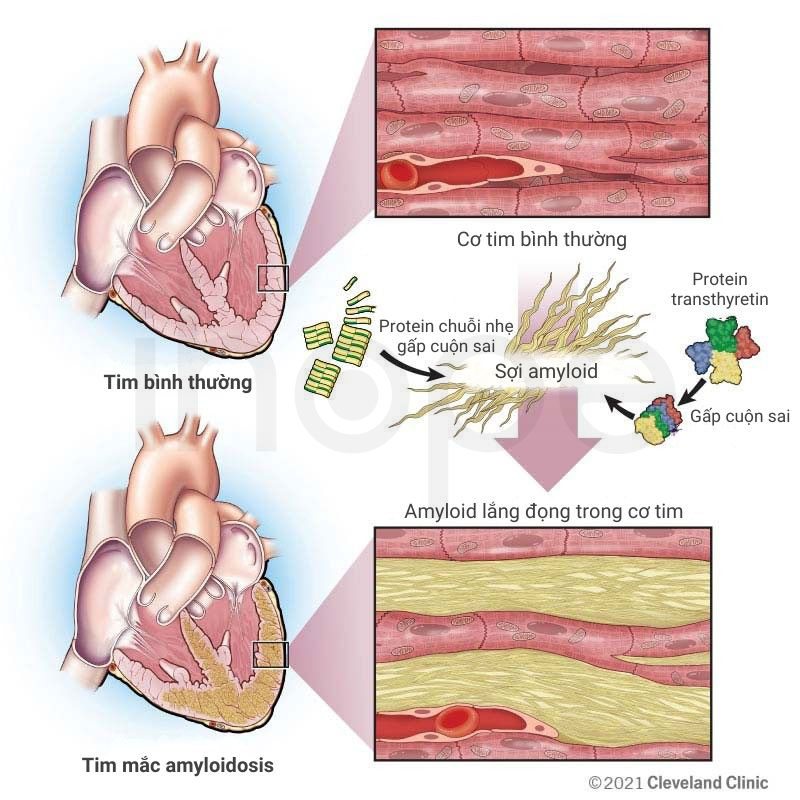 Amyloidosis tim