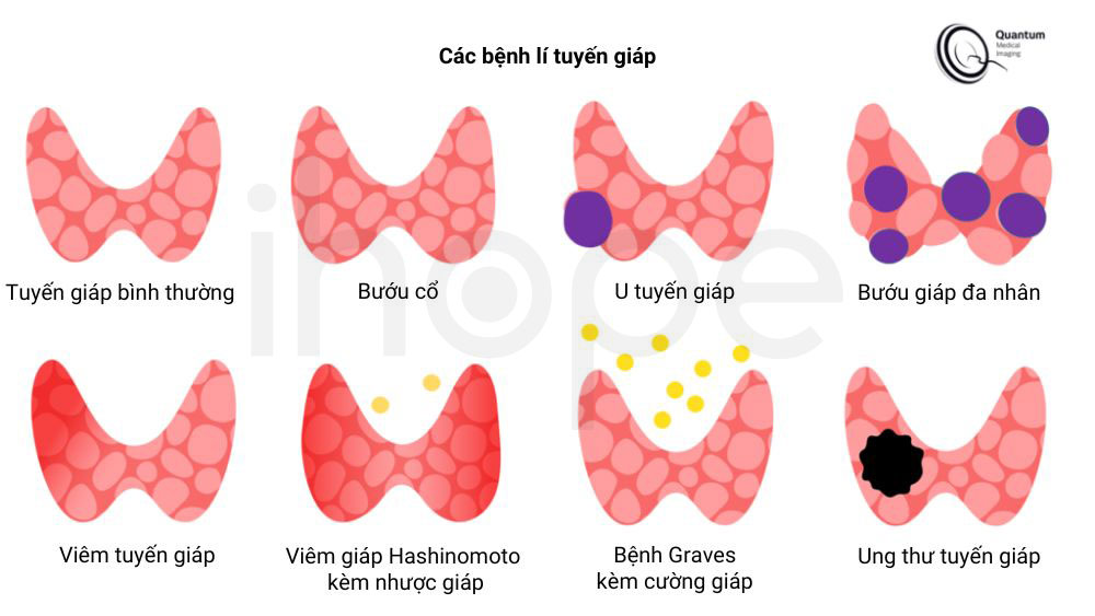 Các bệnh lí tuyến giáp