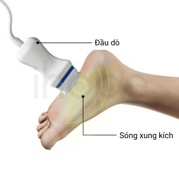 Liệu pháp sóng xung kích ngoài cơ thể