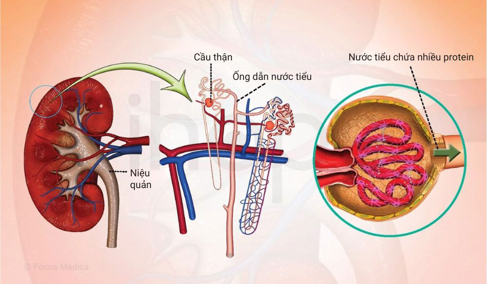 Protein niệu