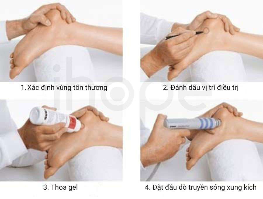 Quy trình điều trị sóng xung kích