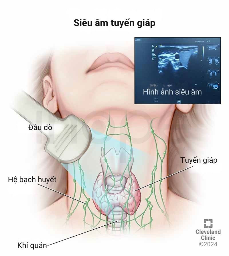 Siêu âm tuyến giáp