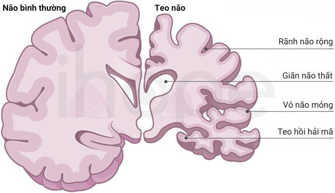 Teo não