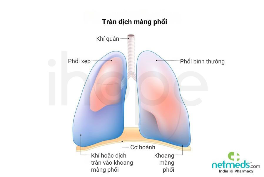 Tràn dịch màng phổi