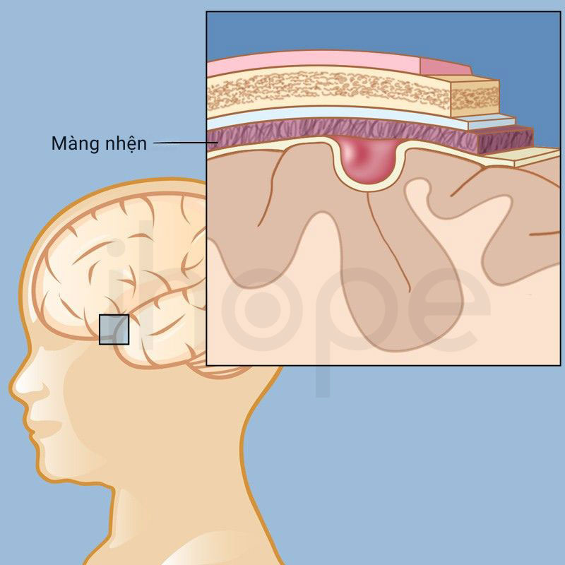 U nang màng nhện
