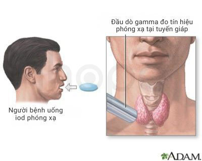 Xét nghiệm iod phóng xạ