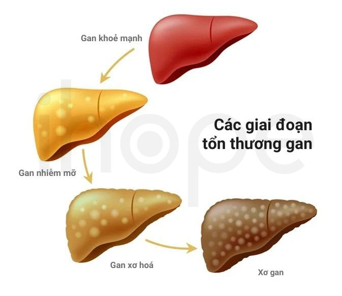 Các giai đoạn tổn thương của gan