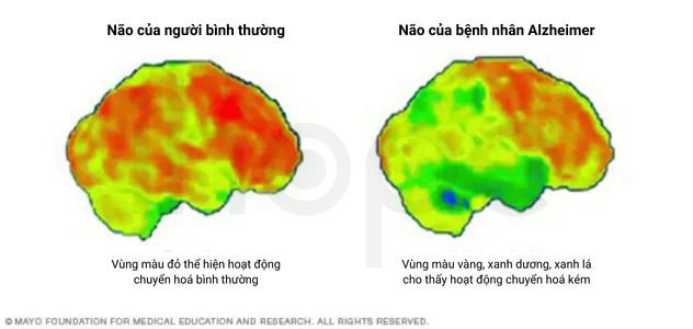 Chụp pet não