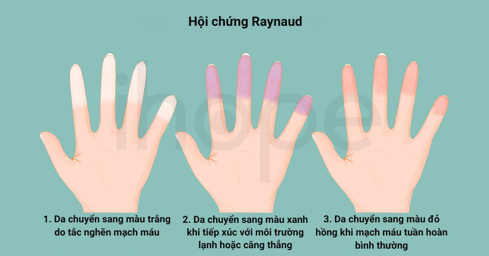 Hoi chung Raynaud