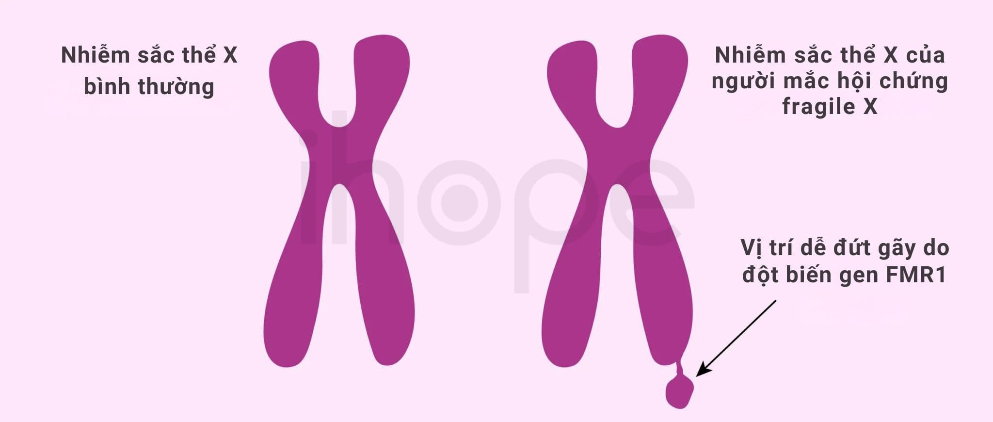 Cấu Trúc Nhiễm Sắc Thể Trong Hội Chứng Fragile X