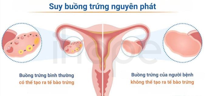 Suy Buồng Trứng Nguyên Phát