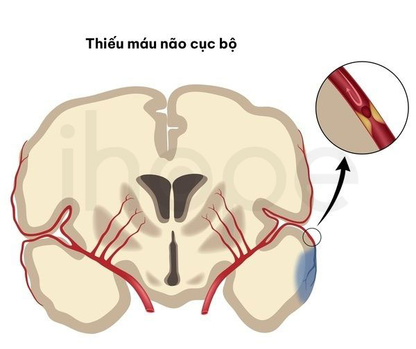 Thieu mau nao cuc bo