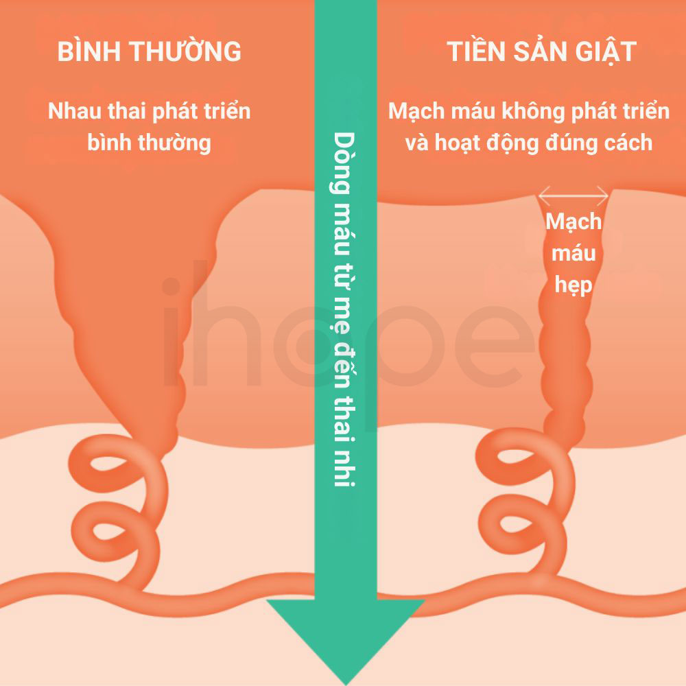 Bat thuong mach mau trong tien san giat