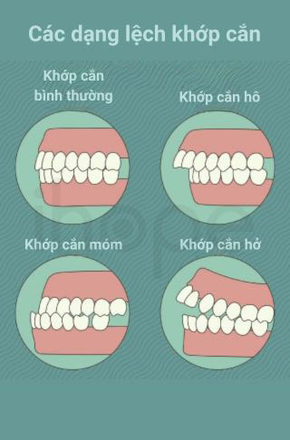 Cac dang lech khop can