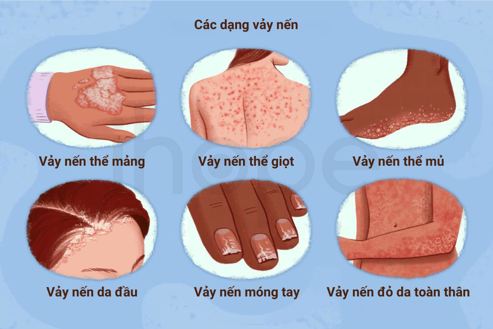 Cac dang vay nen