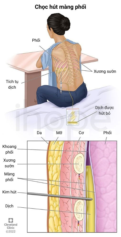Choc hut mang phoi
