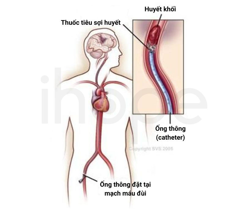 Dat ong thong truyen thuoc tieu soi huyet
