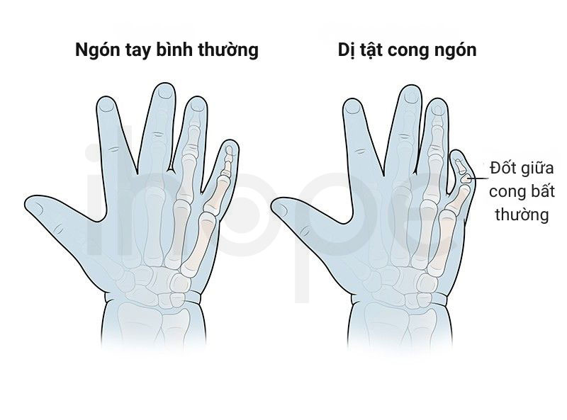 Di tat cong ngon tay