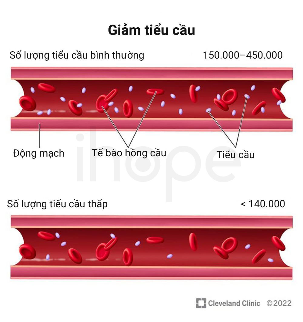 Giam tieu cau