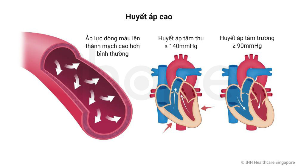 Huyet ap cao