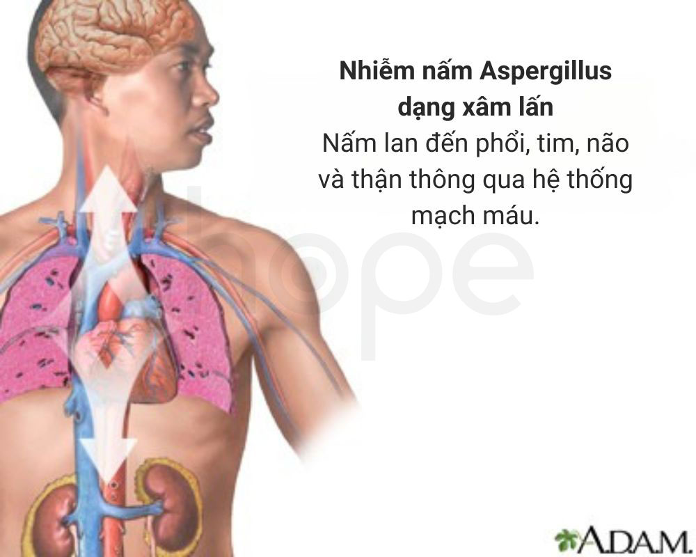 Nhiem nam Aspergillus xam lan