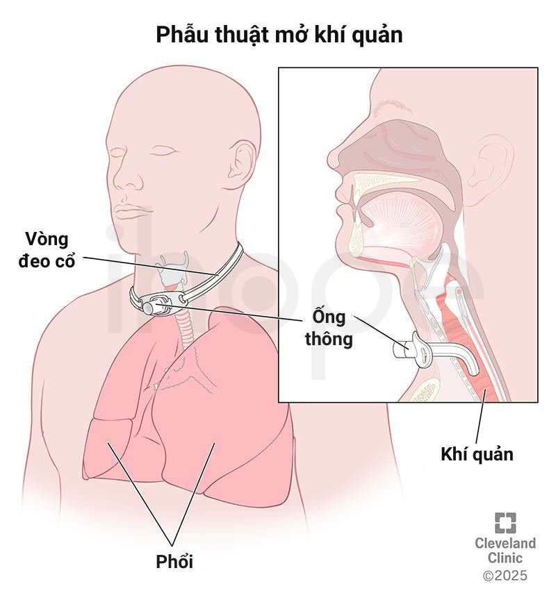 Phau thuat mo khi quan