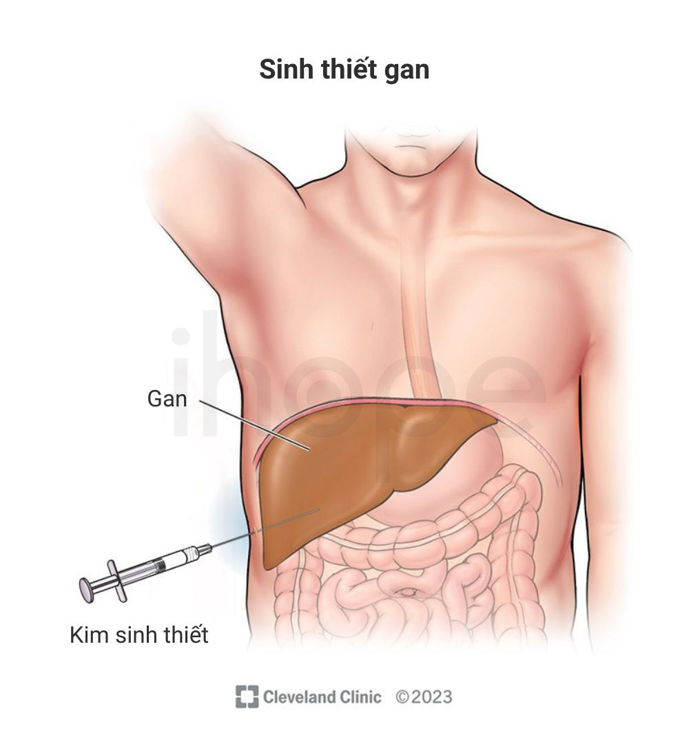 Sinh thiet gan