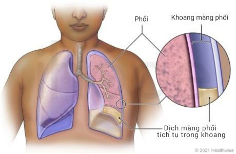 Tran dich mang phoi