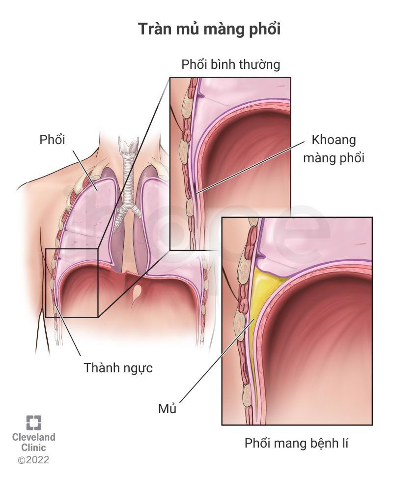 Tran mu mang phoi