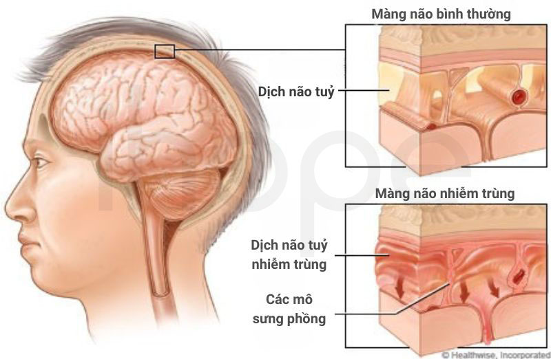 Viem mang nao