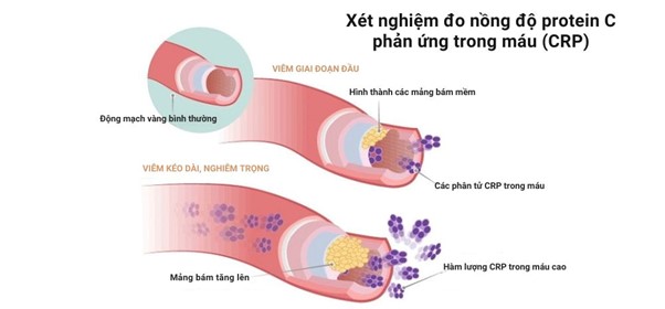 Xet nghiem do nong do protein C phan ung trong mau CRP
