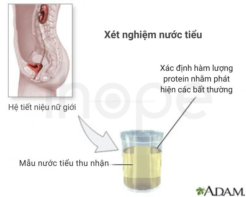 Xet nghiem nuoc tieu