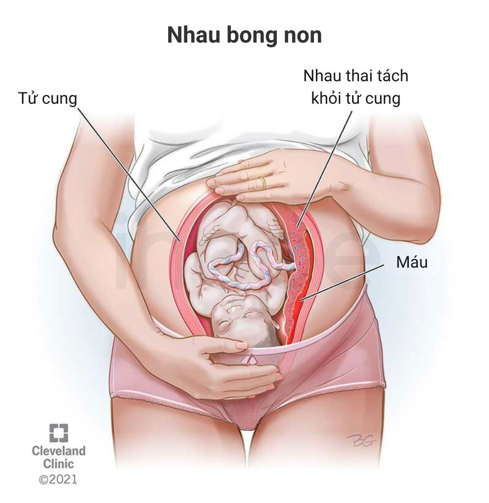 Nhau bong non
