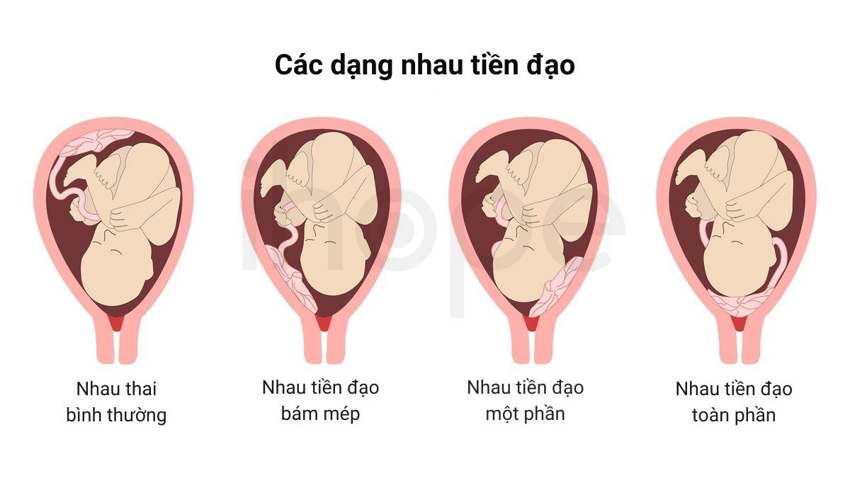 Cac dang nhau thai tien dao