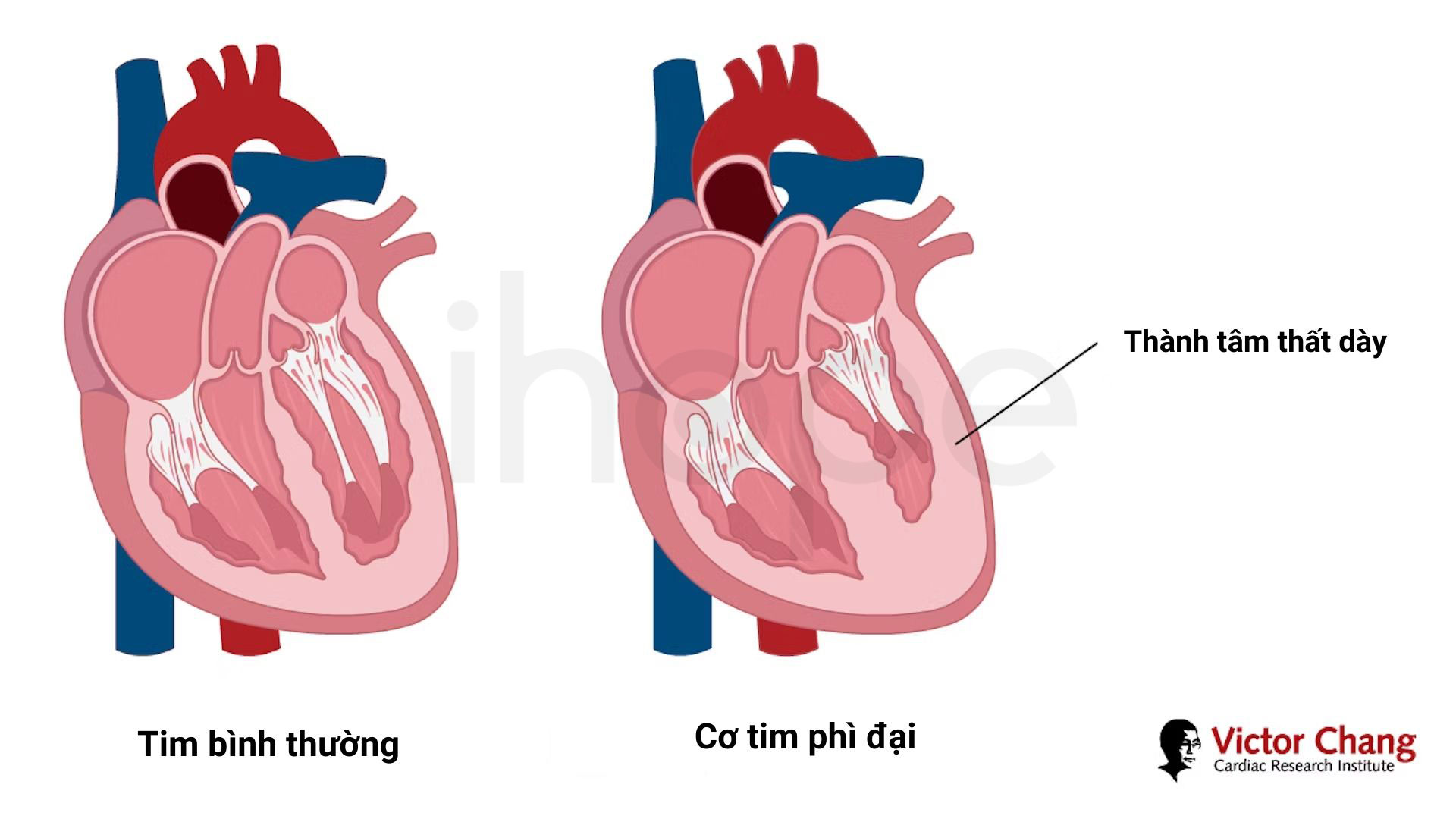 Co tim phi dai