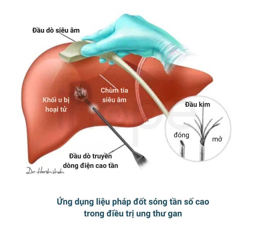 Dieu tri ung thu gan bang lieu phap dot song tan so cao