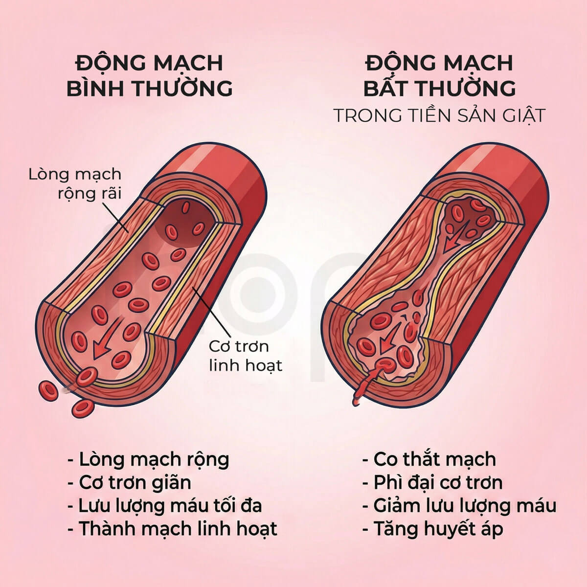Bất thường về mạch máu trong tiền sản giật