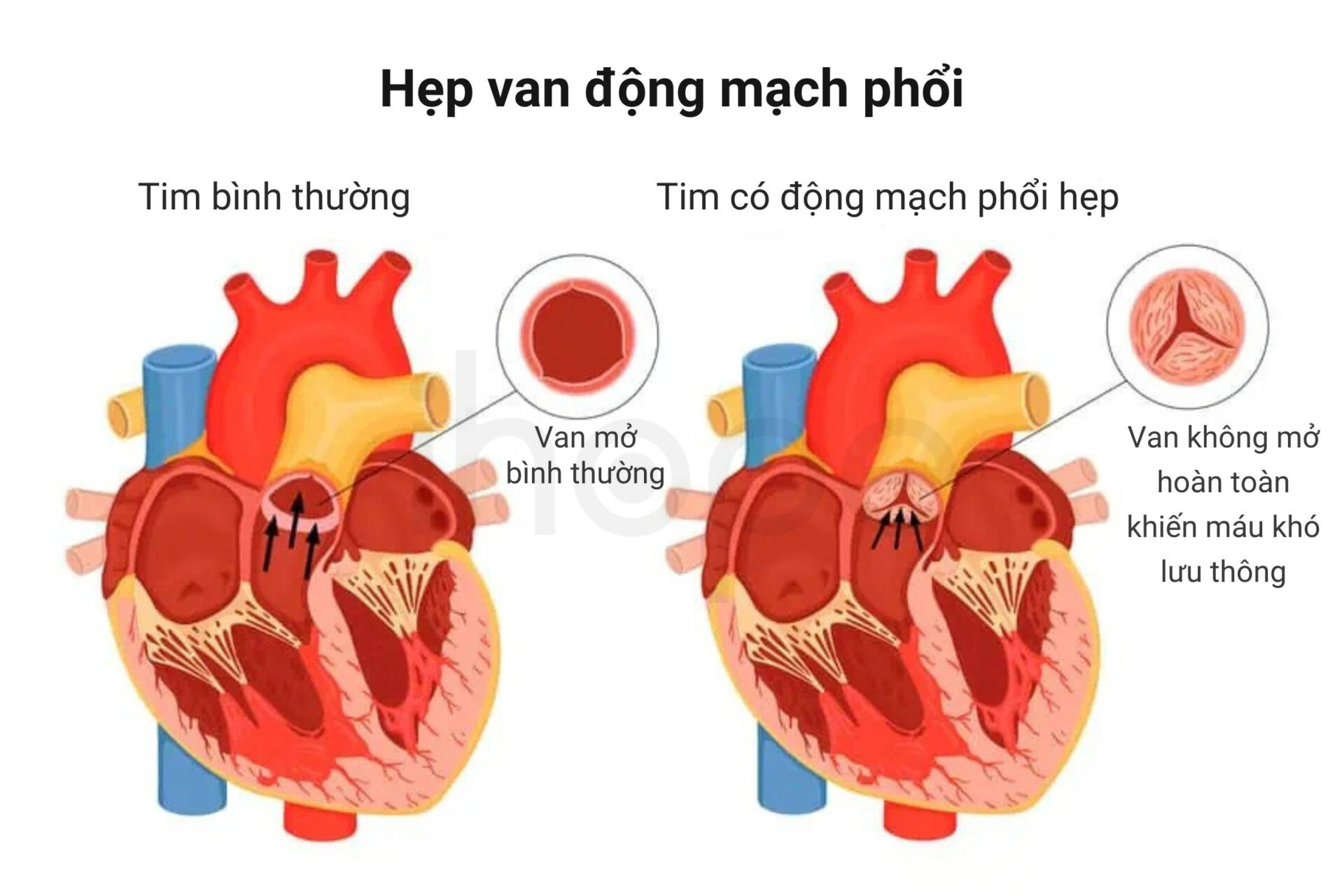 Hep van dong mach phoi