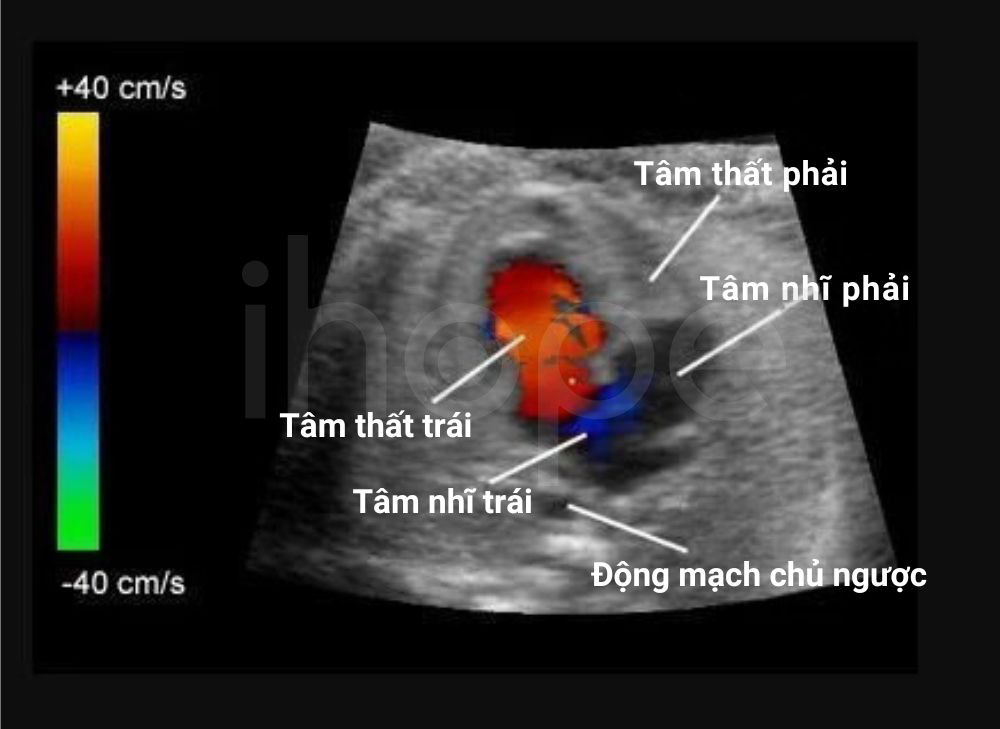 Hinh anh sieu am Doppler