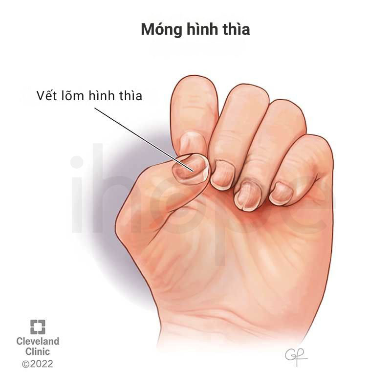 Mong hinh thia