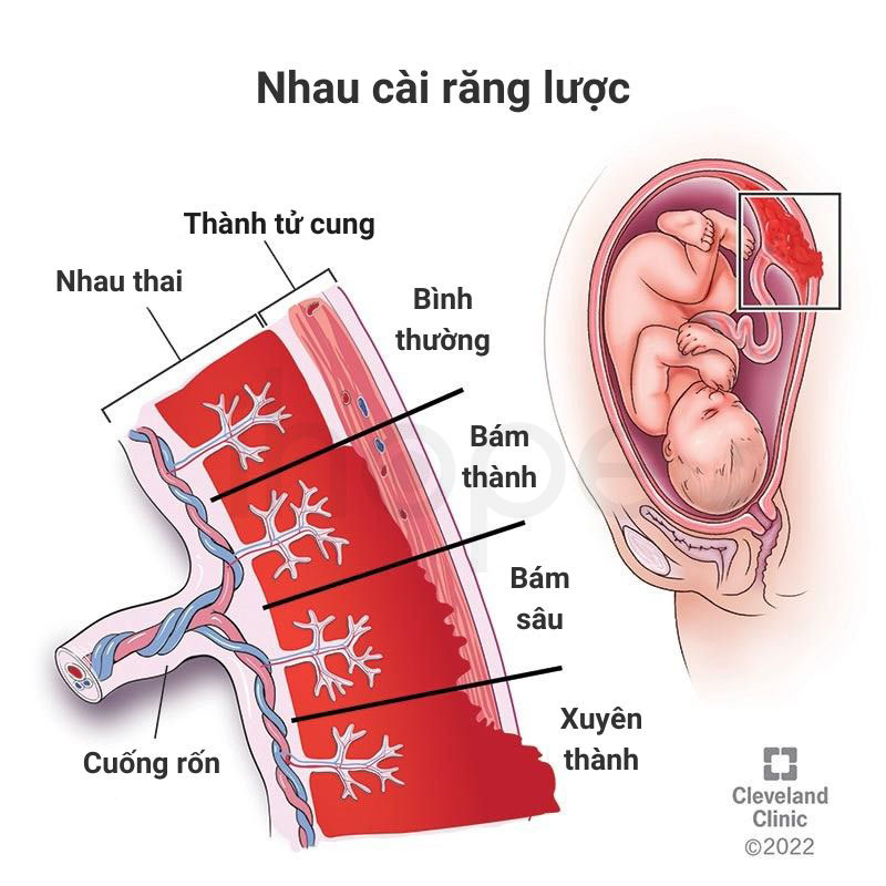 Nhau cai rang luoc