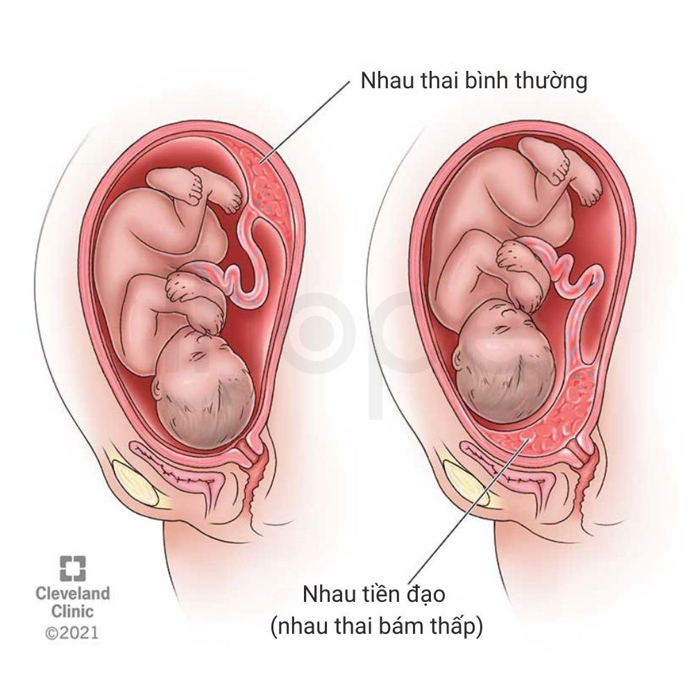 Nhau thai binh thuong va nhau thai tien dao
