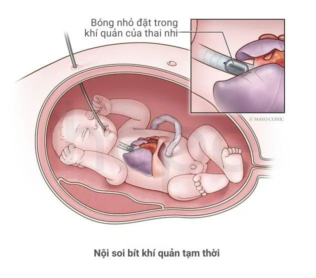 Noi soi bit khi quan tam thoi