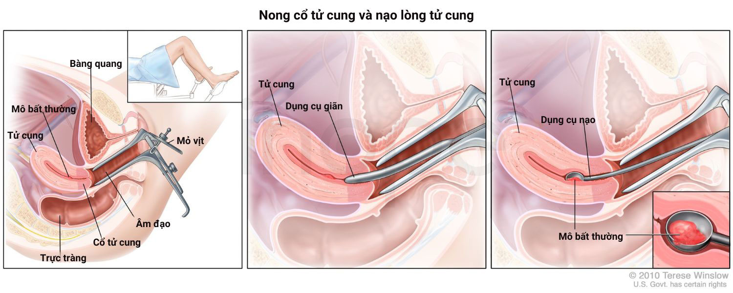 Nong co tu cung va nao long co tu cung