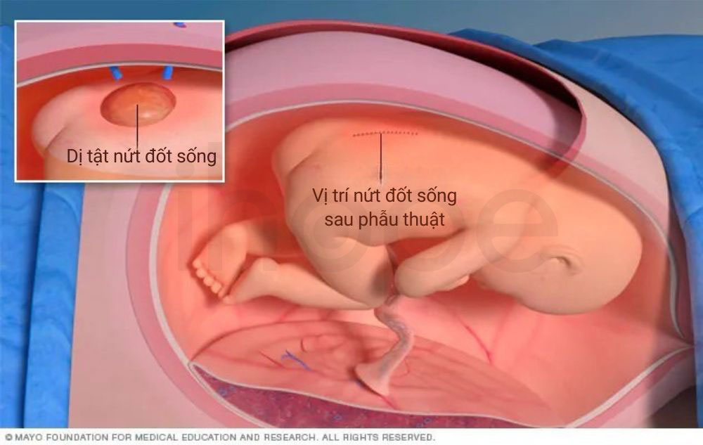 Phau thuat dieu tri tat nut dot song