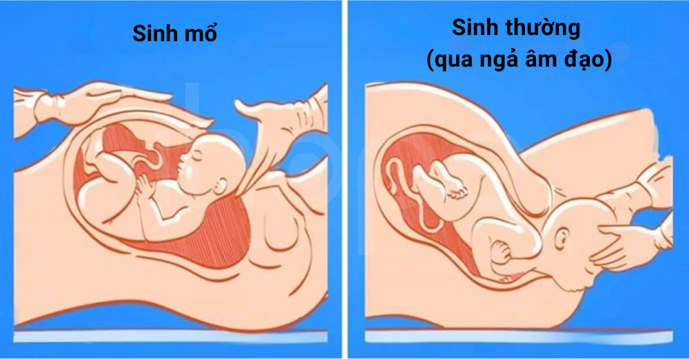 Sinh thuong va sinh mo