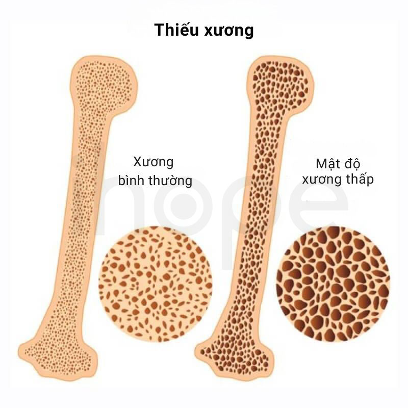 Thieu xuong