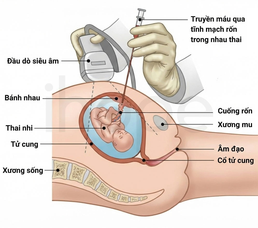 Truyền máu trong tử cung