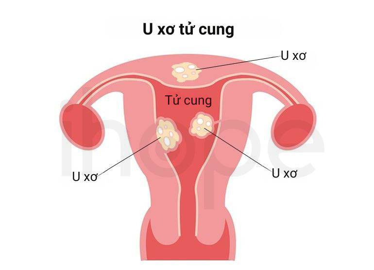 U xo tu cung